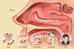 治療鼻息肉需要多少錢？成都仁品耳鼻喉醫(yī)院解答