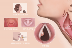 聲帶息肉不能拖-成都耳鼻喉醫院解答