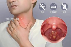 咽炎為何總是反復(fù)發(fā)作？成都咽喉科醫(yī)生幫你解答