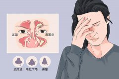 成都鼻竇炎的五大病因你了解嗎？